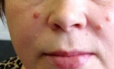 Бородавки на лице лечение