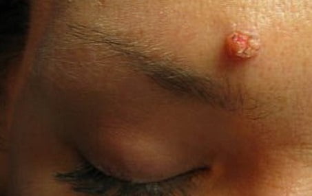 Бородавки на лице