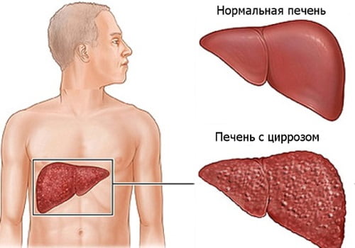 Цирроз печени причины