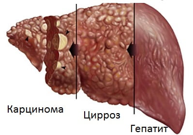 Цирроз печени степени