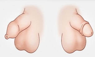 Фимоз у мальчиков фото