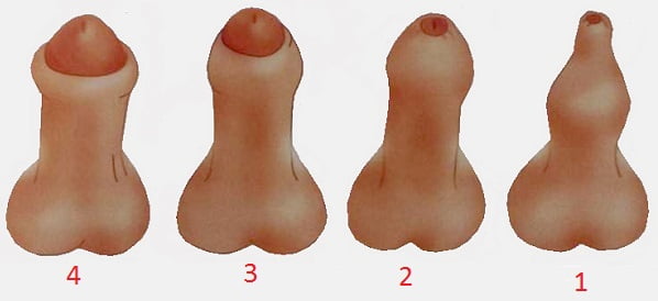 Фимоз у мальчиков симптомы