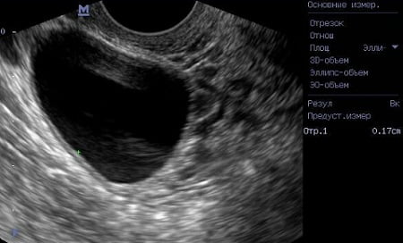 Фолликулярная киста яичника диагностика