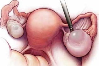 Фолликулярная киста яичника лечение