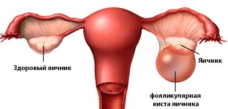 Фолликулярная киста яичника причины