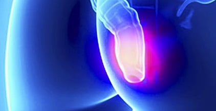 Геморрой у женщин симптомы