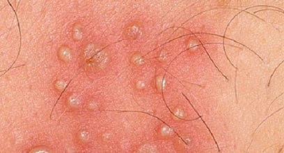 Герпес на интимном месте фото