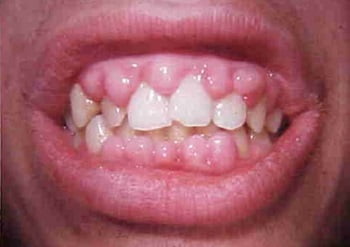 Гипертрофический гингивит фото