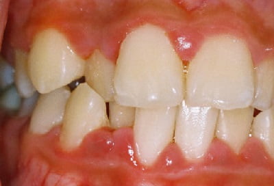 Гипертрофический гингивит лечение