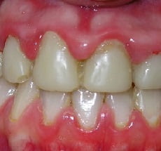 Гипертрофический гингивит