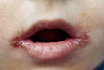 Хейлит на губах