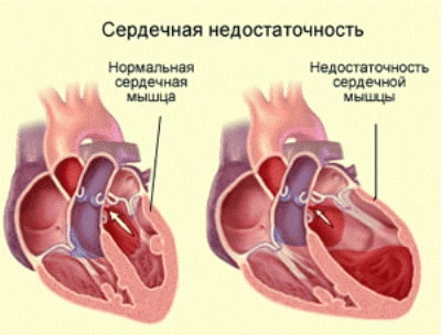 Хроническая сердечная недостаточность причины