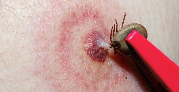 Как выглядит укус клеща у человека
