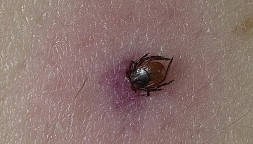 Клещевой энцефалит лечение