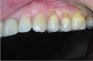 Клиновидный дефект зубов фото