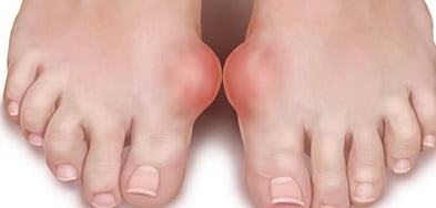 Косточка на большом пальце ноги лечение