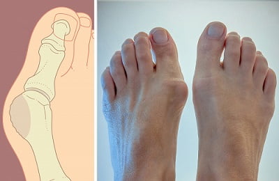 Косточка на большом пальце ноги симптомы