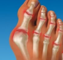 Косточка на большом пальце ноги