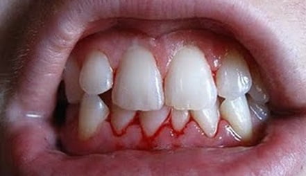 Кровоточат десны фото