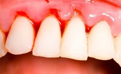 Кровоточат десны причины