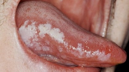 Лейкоплакия полости рта фото