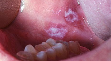 Лейкоплакия полости рта лечение