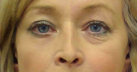 Мешки под глазами фото