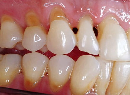 Пришеечный кариес фото