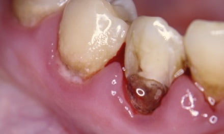 Пришеечный кариес лечение