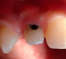 Пришеечный кариес