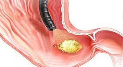Прободная язва желудка симптомы