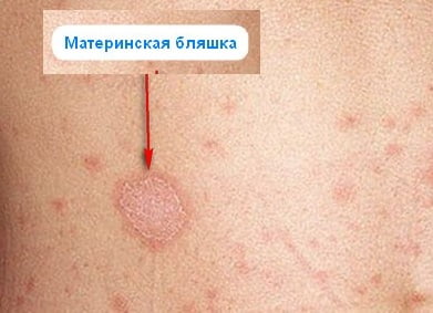 Розовый лишай фото