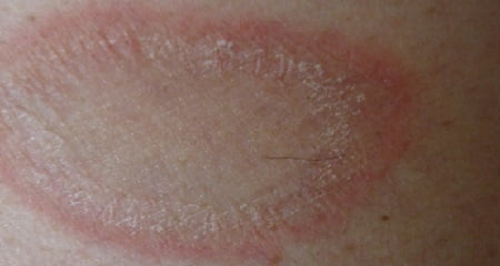 Розовый лишай лечение