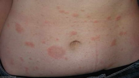 Розовый лишай причины