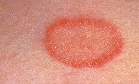 Розовый лишай симптомы