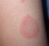 Розовый лишай