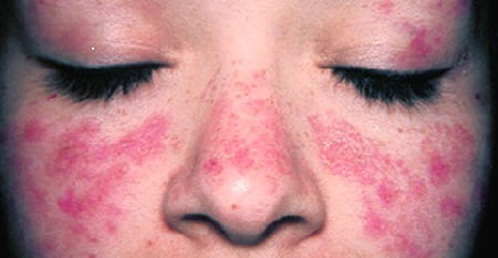 волчанка фото