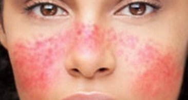 Системная красная волчанка лечение