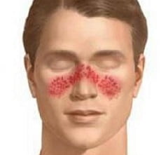 Системная красная волчанка