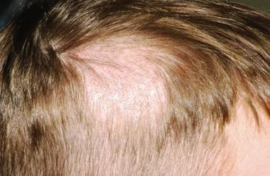 Стригущий лишай у человека лечение