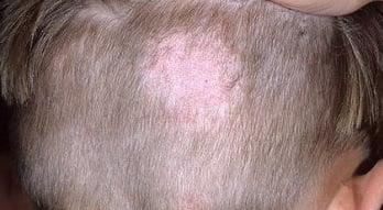 Стригущий лишай у человека