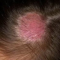 Стригущий лишай