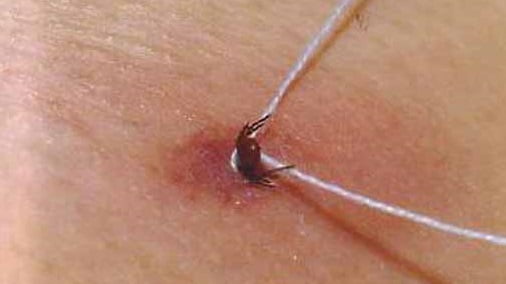 Укус клеща у человека что делать