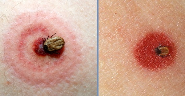 Если при укусе наблюдается покраснение&nbsp;— это может быть нормальная аллергическая реакция. Но красные пятна, достигшие в диаметре 10-12 см, могут являться симптомом болезни Лайма 