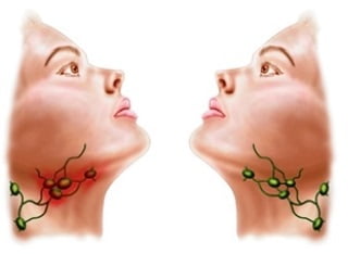 Увеличение подчелюстных лимфоузлов лечение