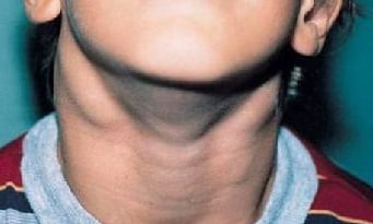 Увеличение подчелюстных лимфоузлов симптомы