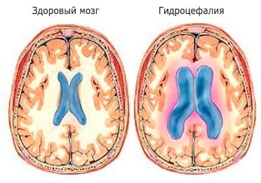 Внутричерепное давление у детей
