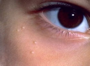 Жировики на лице лечение