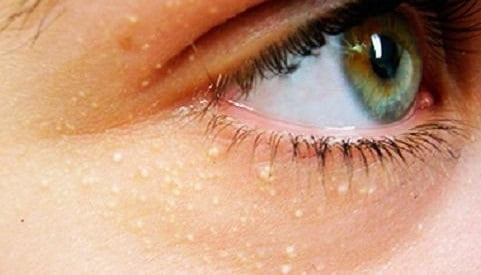 Жировики на лице причины