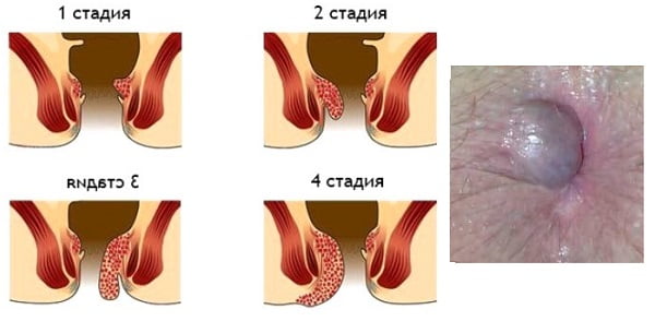 геморрой у женщин стадии